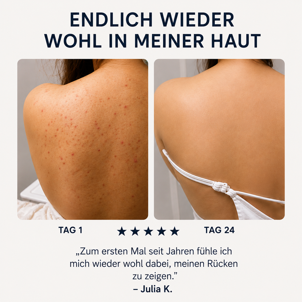 Zanari Rückenseife gegen Akne