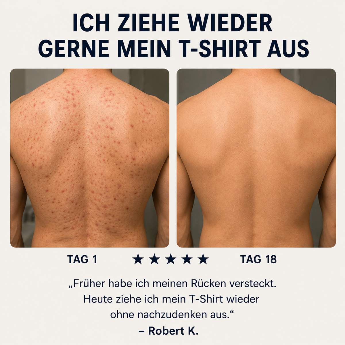 Zanari Rückenseife gegen Akne