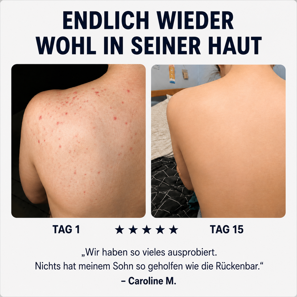 Zanari Rückenseife gegen Akne