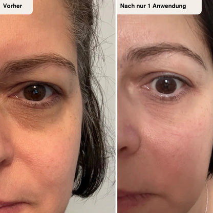 Zanari Microneedling-Augenpads